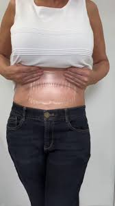 Patch liftants Eclat Sublime SilkWoman™